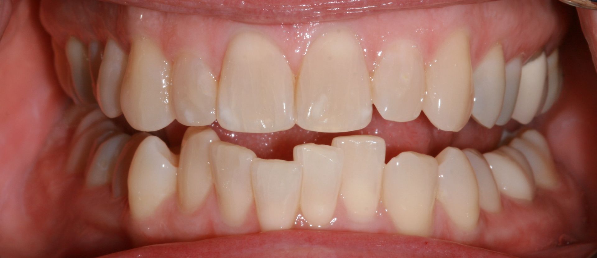 A close up of a person 's teeth with a broken tooth.