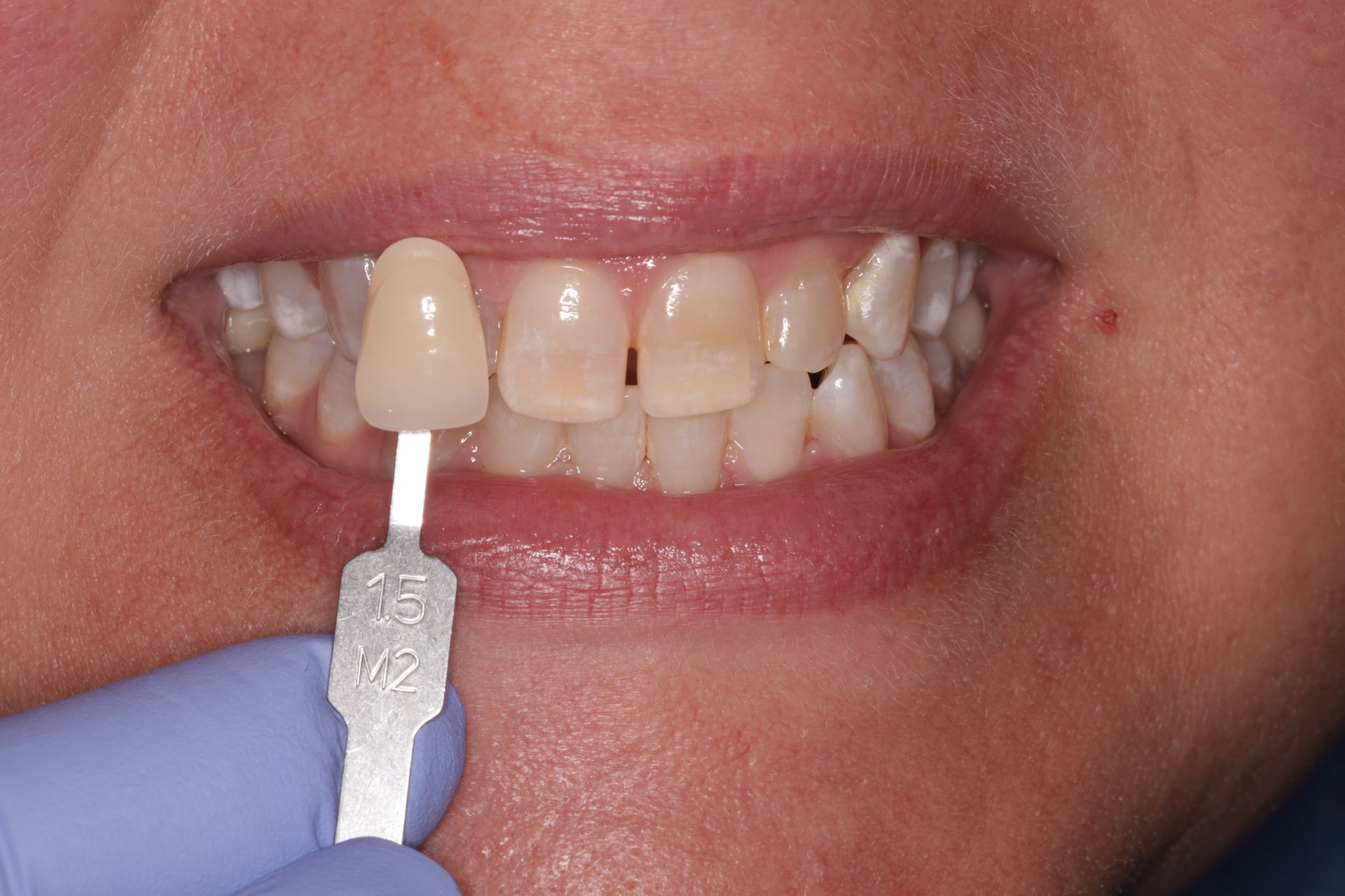 A person is holding a tooth color chart in front of their teeth.