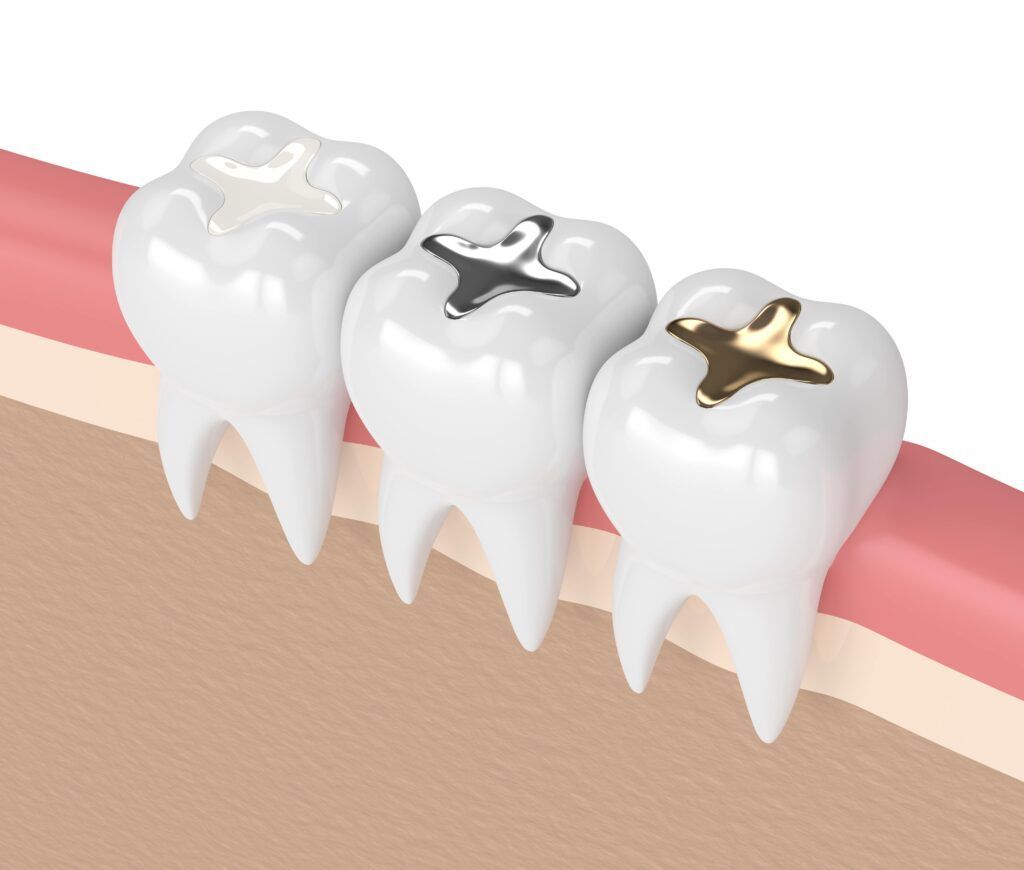 A row of teeth with different types of fillings in them.