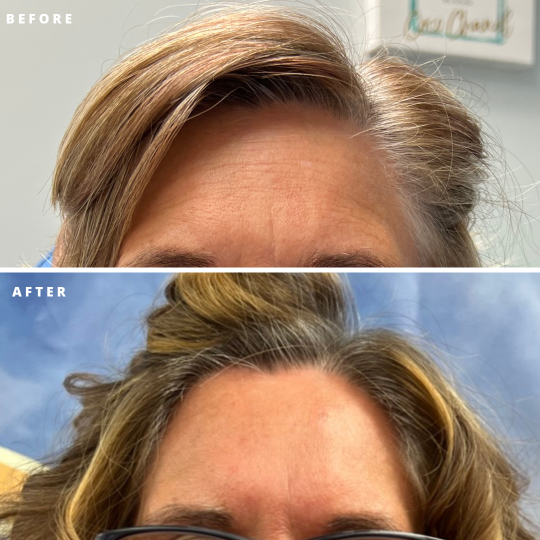 A before and after picture of a woman 's forehead with glasses.