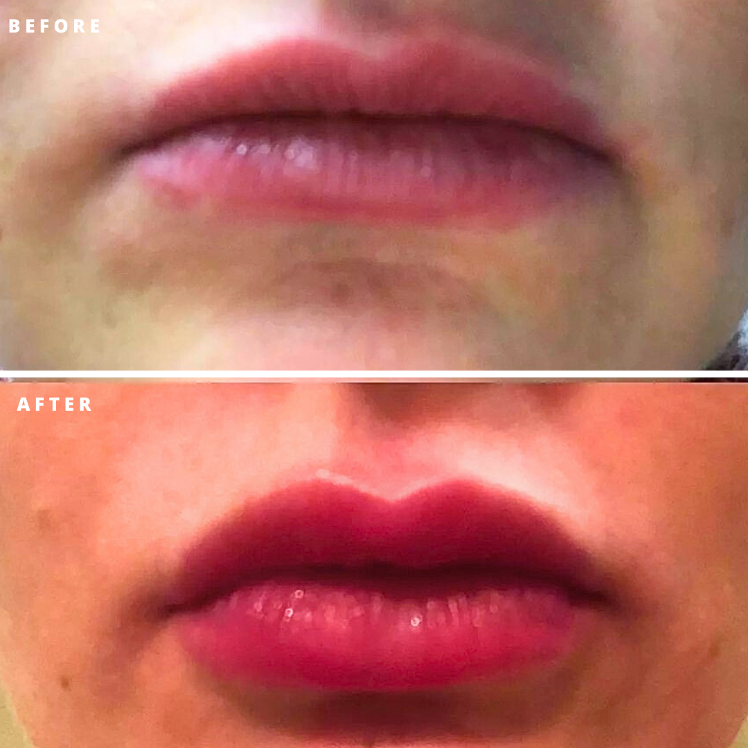 A before and after photo of a woman 's lips.