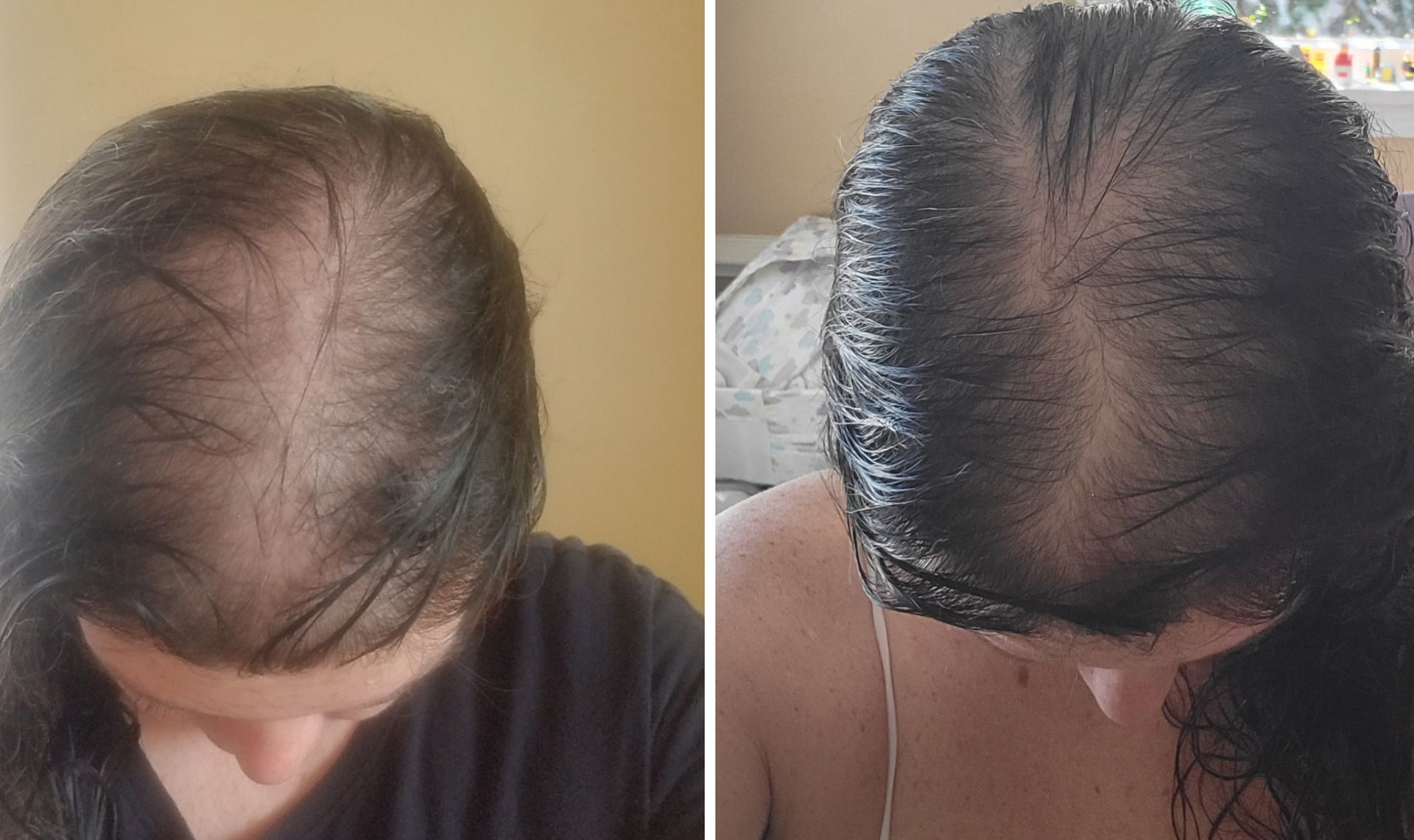 A before and after photo of a woman 's hair growth.