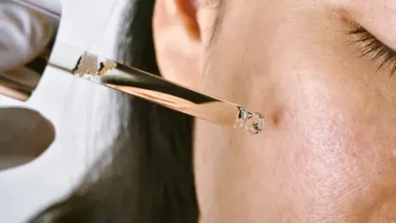 A pipette dispensing liquid onto a person's cheek near a blemish. Close-up, bright lighting.