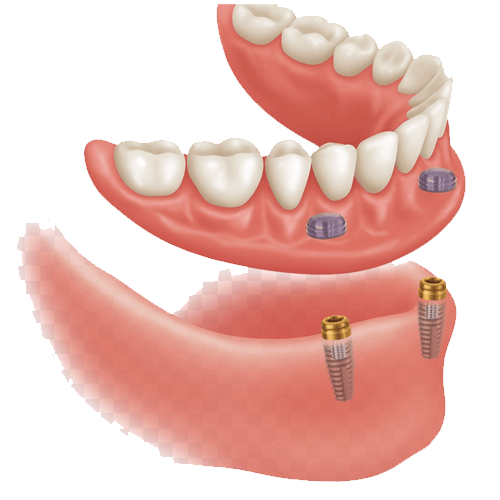 Implant Dentures Coppell