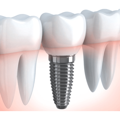 Implant Crowns Coppell