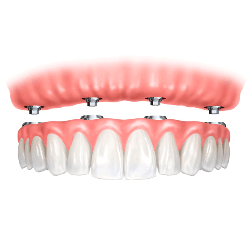 All on 4 Dental Implants Coppell