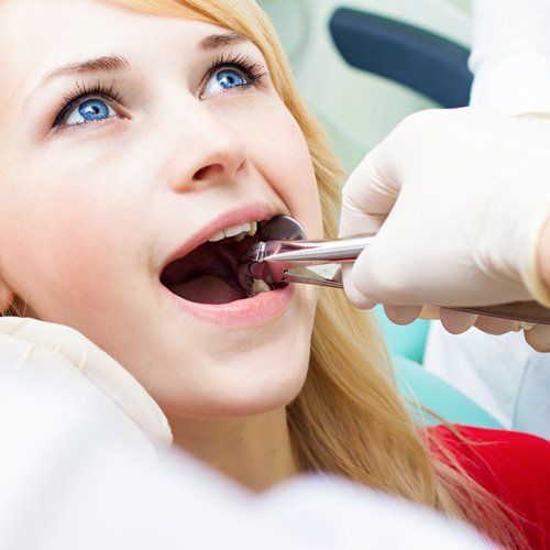 Tooth Extraction Coppell