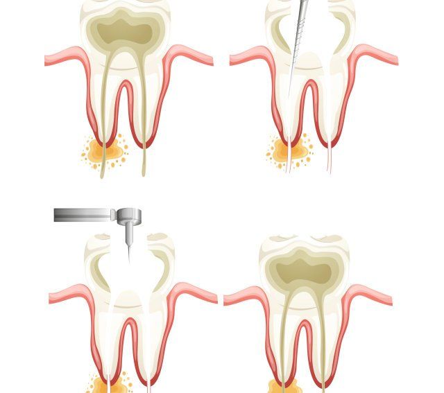 Root Canal Coppell