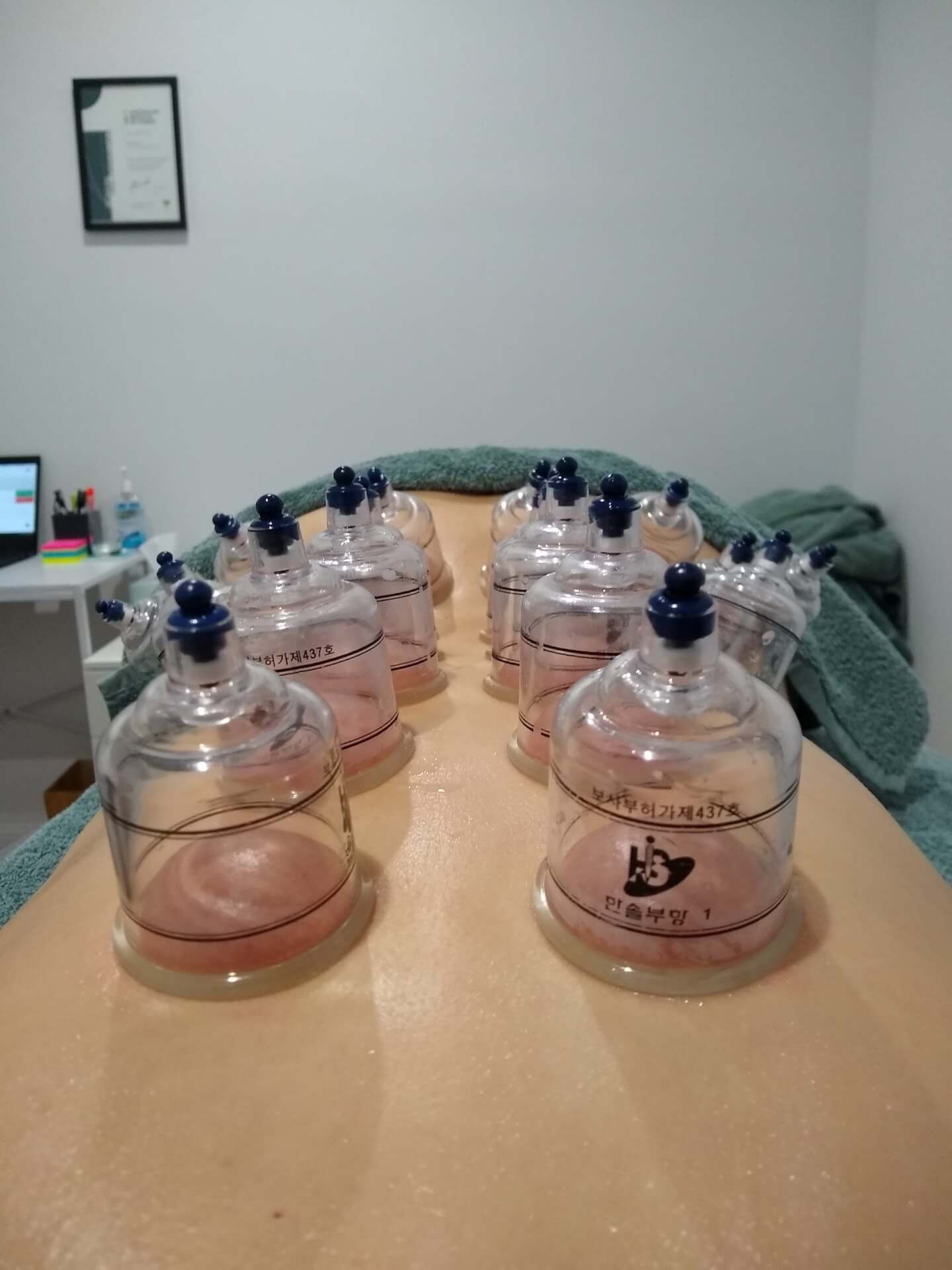 Myofascial Cupping Adelaide