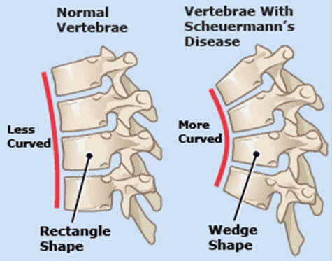 Scheuermann's Disease also known as Scheuermann’s kyphosis