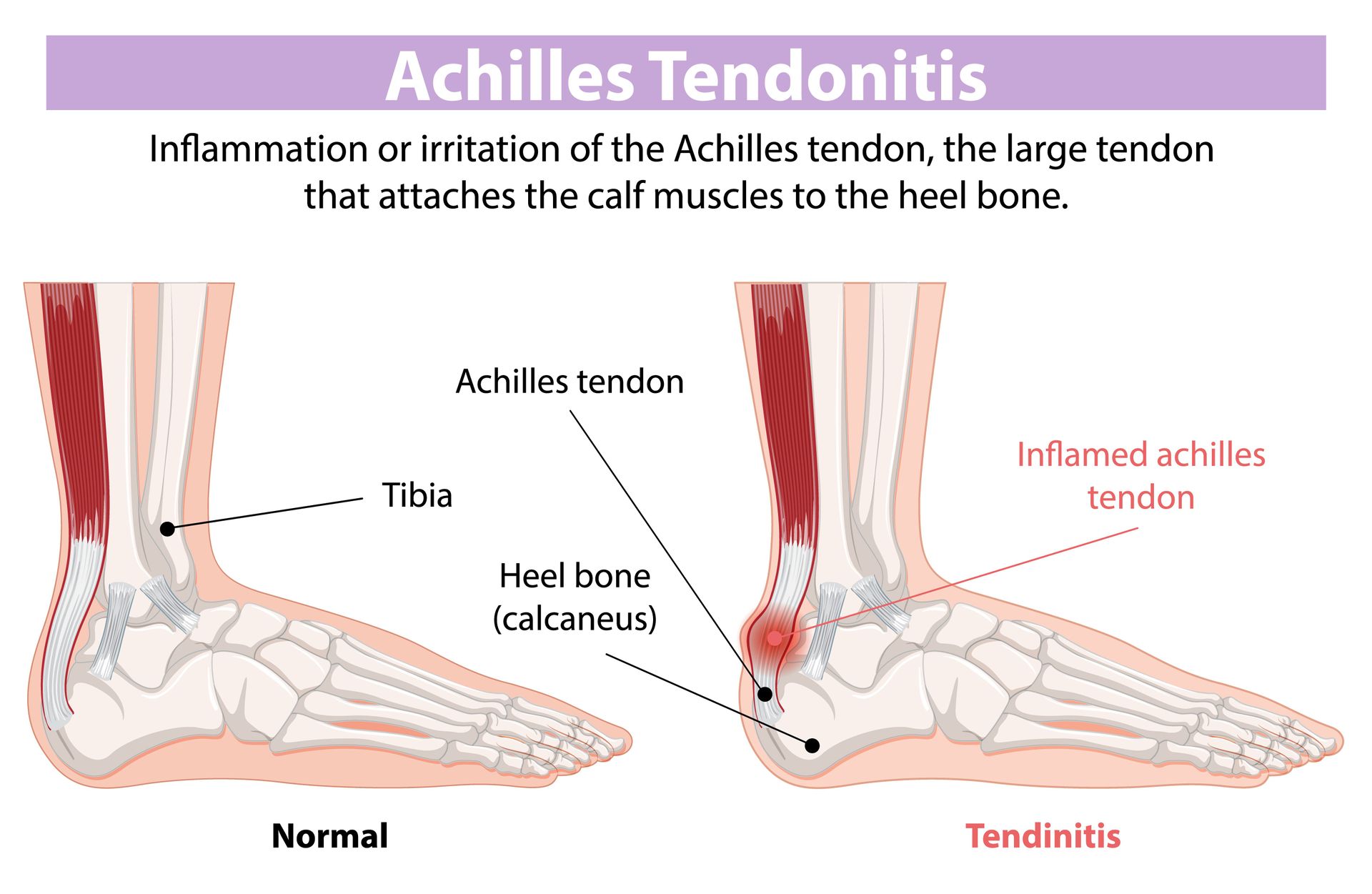 Achilles Tendon Rupture Pain Treatment Adelaide Chiropractors And Remedial Massage Therapists