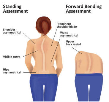 Chiropractor performing the Forward Adam Bend Test to screen for scoliosis in a child.