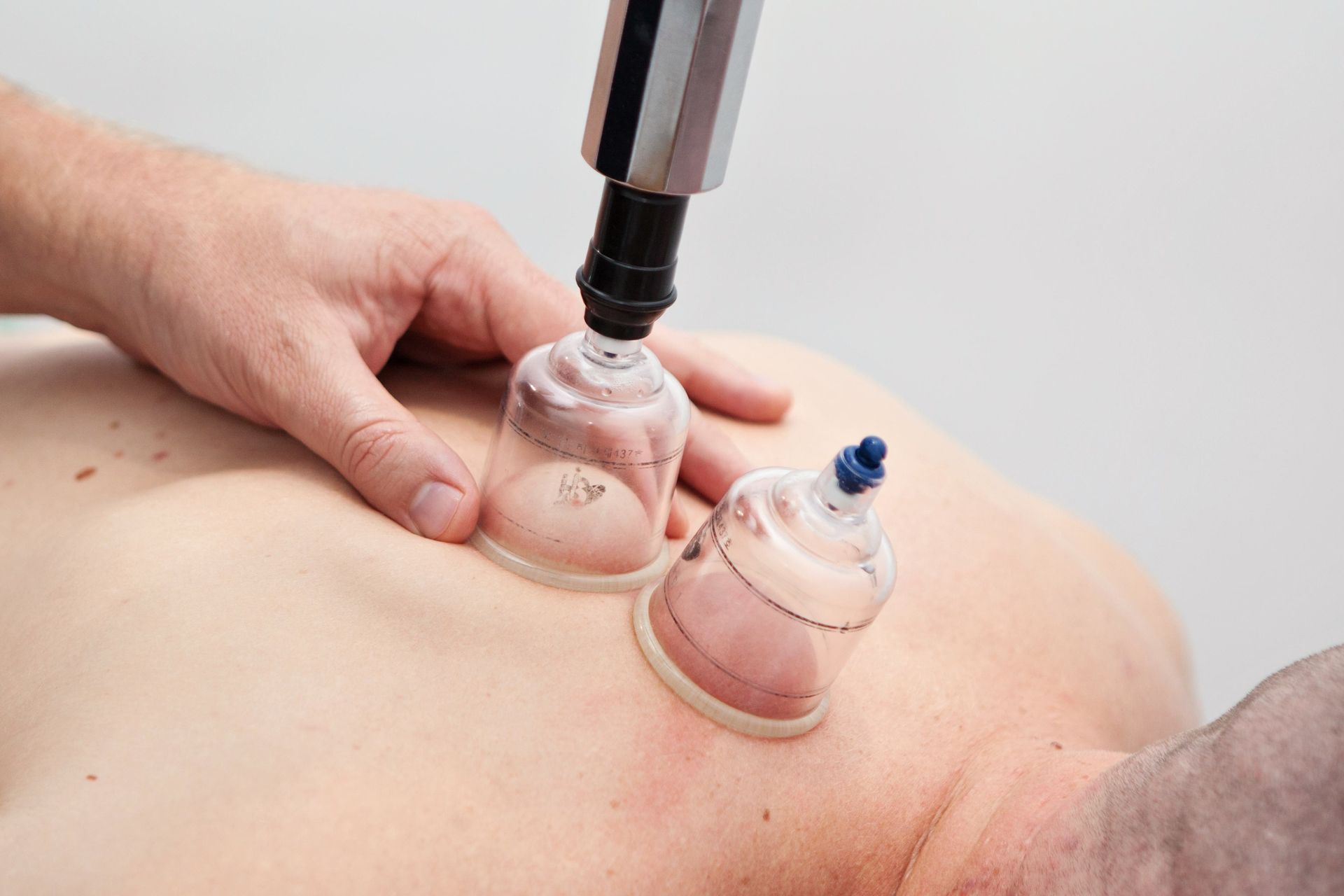 Cupping Treatment Adelaide