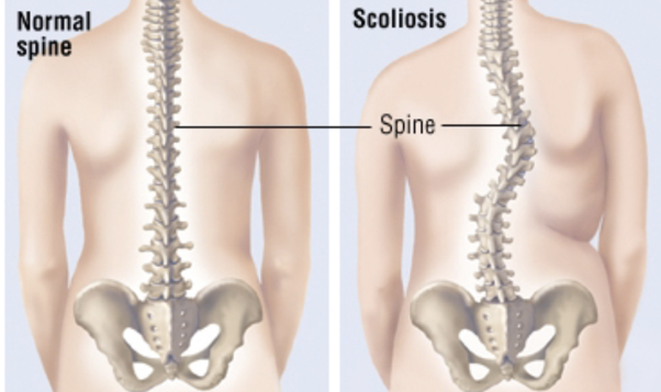 Comparison between a normal spine and a scoliotic spine shown during postural analysis.