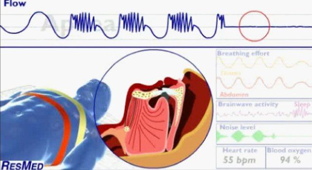 Diagram showing sleep apnea, with breathing flow and body scan of the airway.