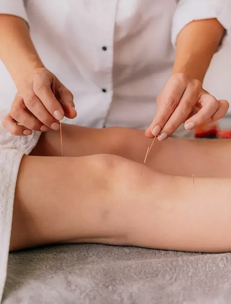 Person inserting acupuncture needles into a knee. White shirt, neutral-toned setting.