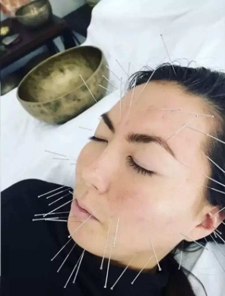Woman with acupuncture needles in her face, lying down next to a singing bowl.