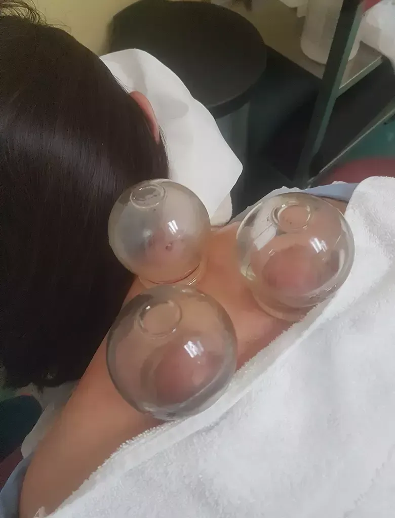 A person's shoulder with three cupping therapy cups attached, setting is indoors.