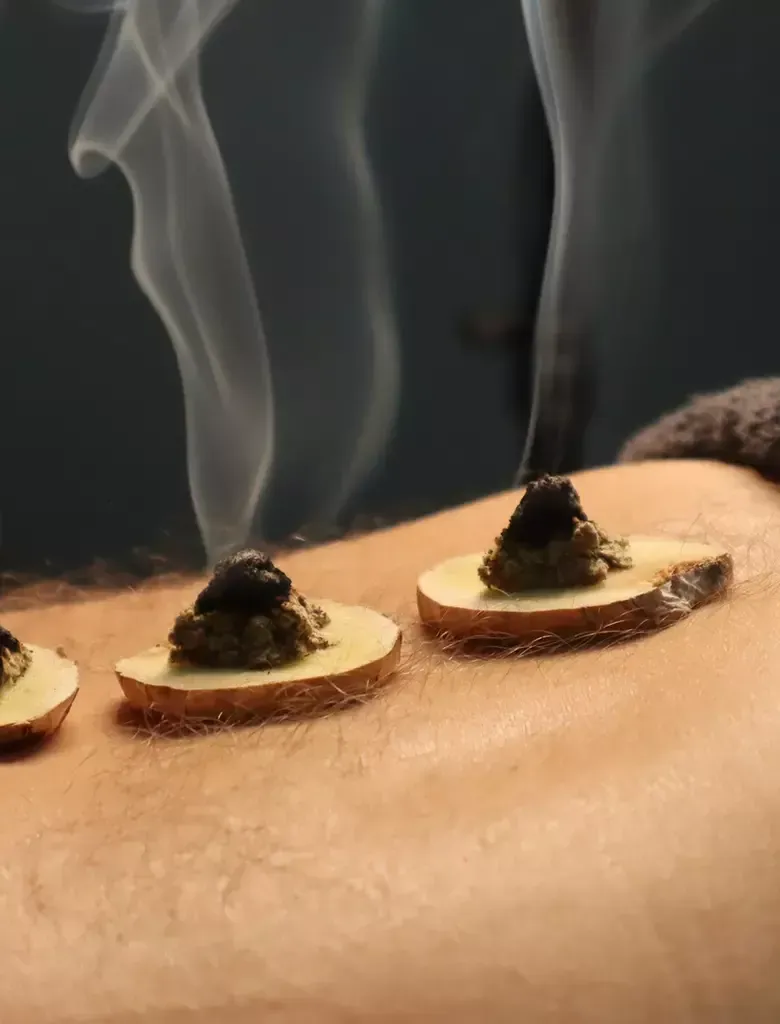 Smoking moxibustion treatment: Small burning mounds on wooden bases on a person's skin. Smoke rises.