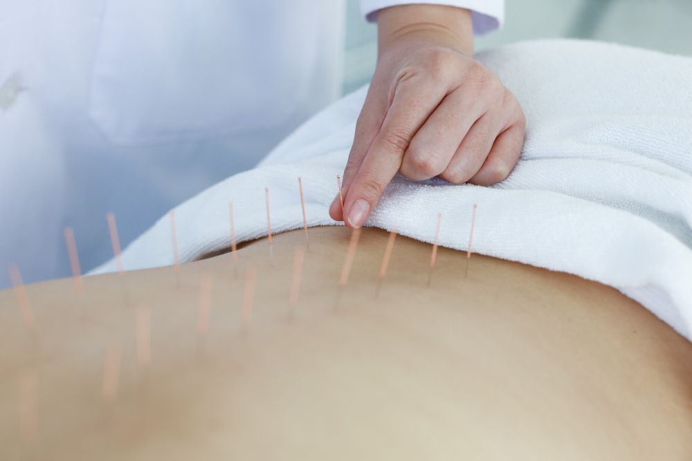 Person receiving acupuncture; needles in back. A hand points to one needle.
