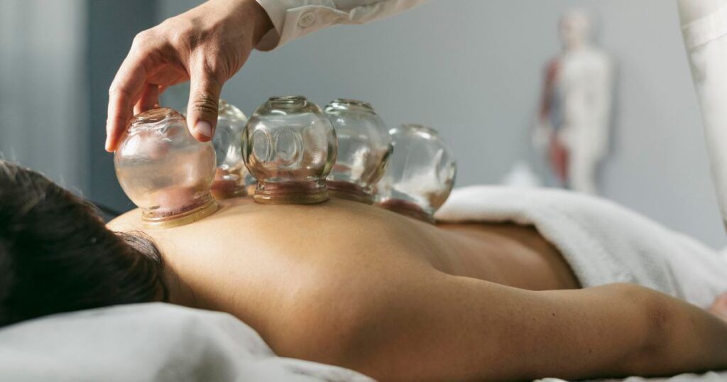 cupping in Coral Gabbles in Miami