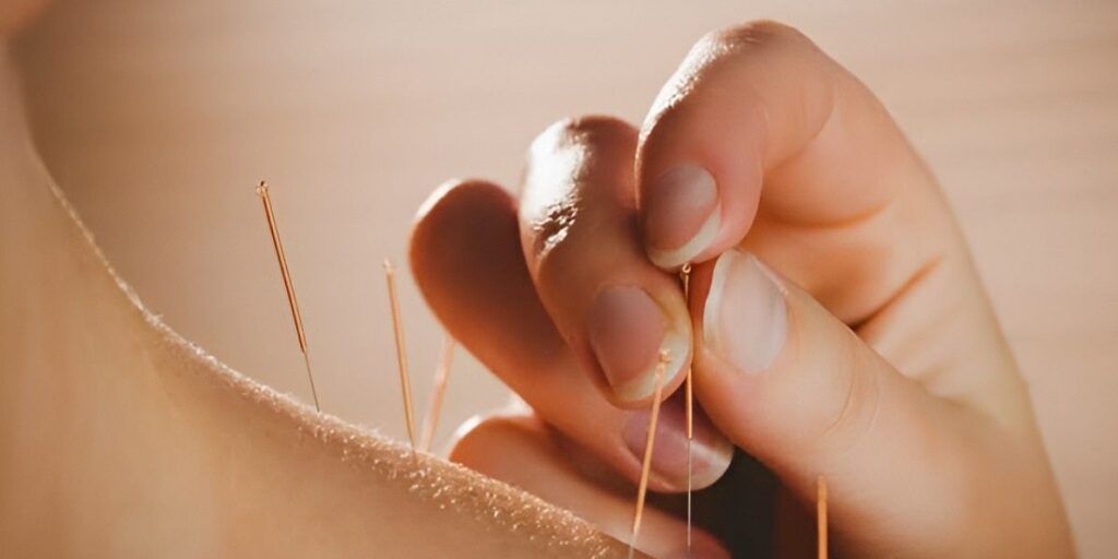 Close-up of a hand holding acupuncture needles in skin. Beige color.