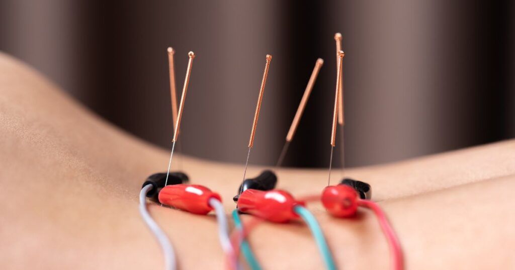 Close-up of arm with acupuncture needles connected to electrodes for electroacupuncture.