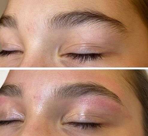 Microdermabrasion Of The Facial Skin Of A Beautiful Woman — Erikka's All Occasion Beauty In Rockhampton City QLD