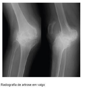 artrose-valgo-joelho-dr-diego-munhoz-ortopedista-especialista-cirurgia-joelho-sao-paulo