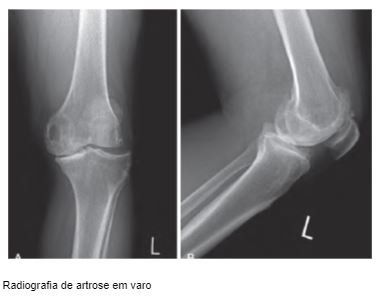 artrose-varo-joelho-dr-diego-munhoz-ortopedista-especialista-cirurgia-joelho-sao-paulo