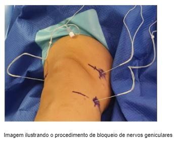 bloqueio-nervos-geniculares-joelho-dr-diego-munhoz-ortopedista-especialista-cirurgia-joelho-sao-paulo