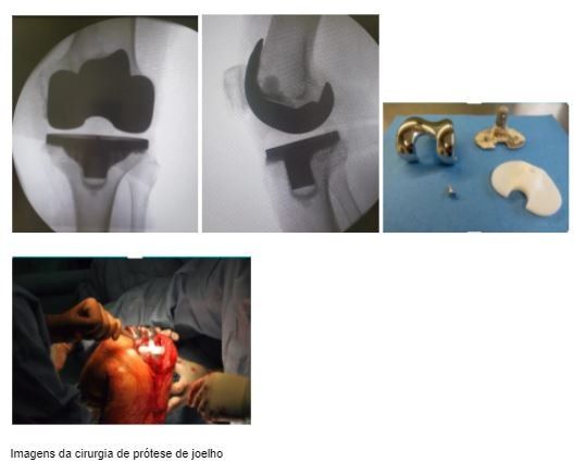 cirurgia-protese-joelho-dr-diego-munhoz-ortopedista-especialista-cirurgia-joelho-sao-paulo