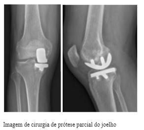 cirurgia-protese-parcial-joelho-dr-diego-munhoz-ortopedista-especialista-cirurgia-joelho-sao-paulo