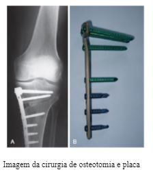 osteotomia-joelho-dr-diego-munhoz-ortopedista-especialista-cirurgia-joelho-sao-paulo