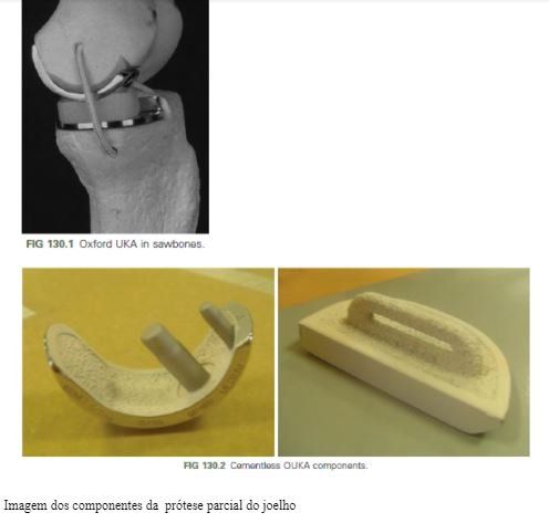 protese-parcial-joelho-dr-diego-munhoz-ortopedista-especialista-cirurgia-joelho-sao-paulo