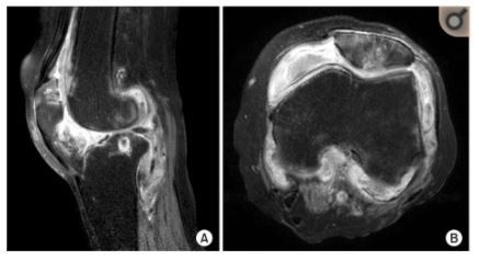 ressonancia-artrose-joelho-dr-diego-munhoz-ortopedista-especialista-cirurgia-joelho-sao-paulo