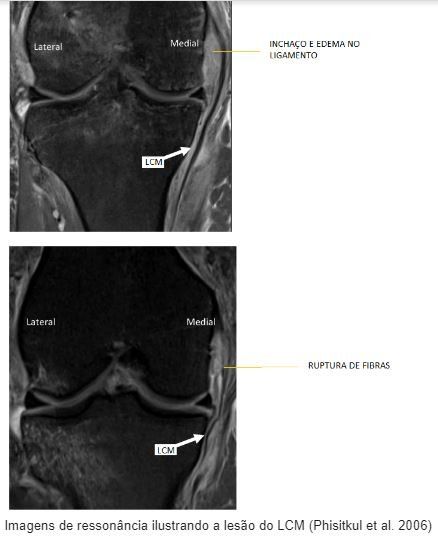 3 Formas de Fortalecer o Ligamento Colateral Medial (LCM)