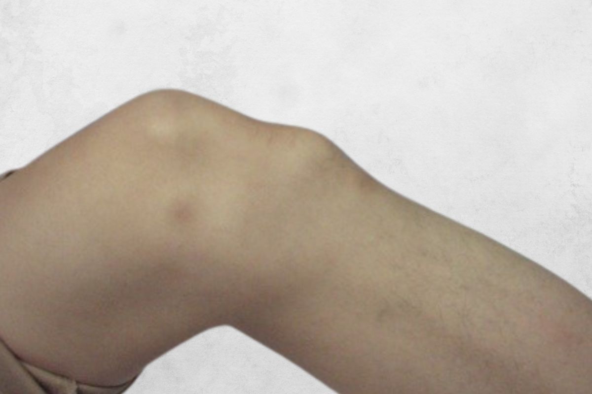 Síndrome de Osgood-Schlatter: diagnóstico e tratamento
