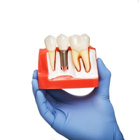 Implant Supported Dentures