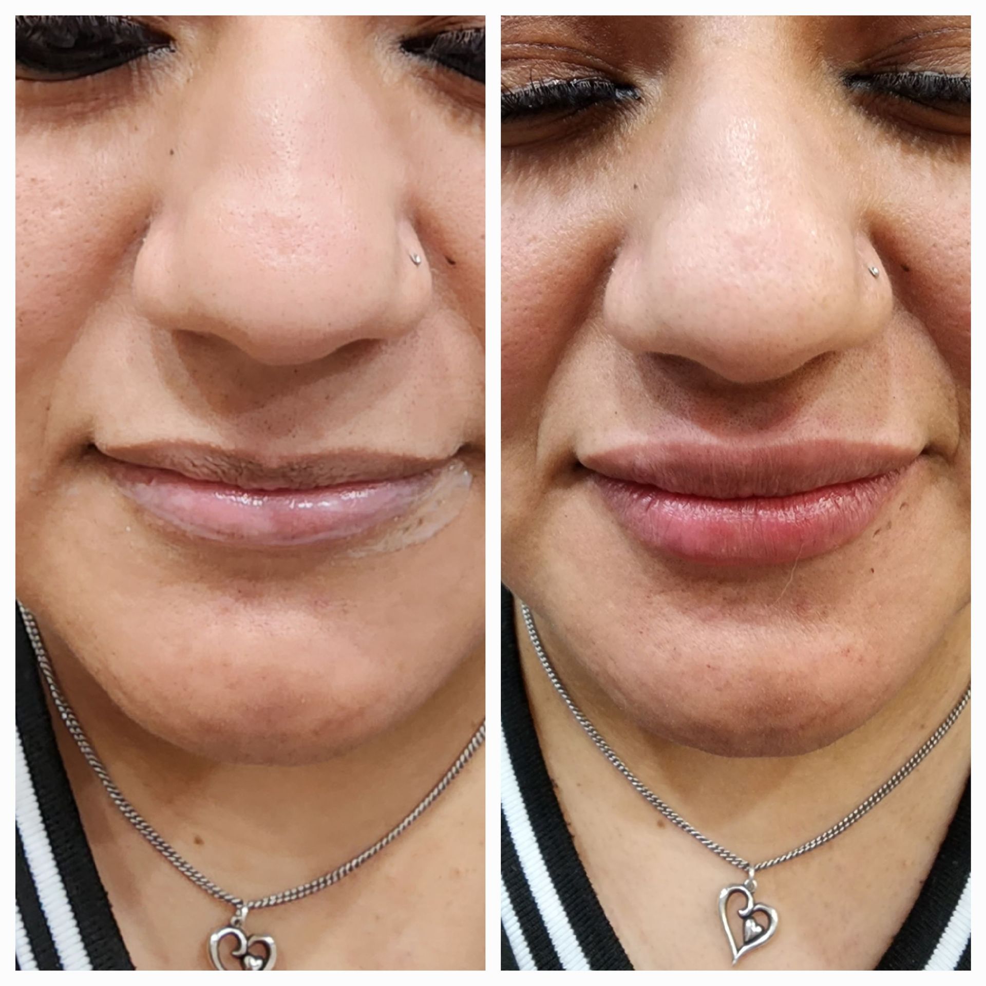 A before and after photo of a woman 's lips.