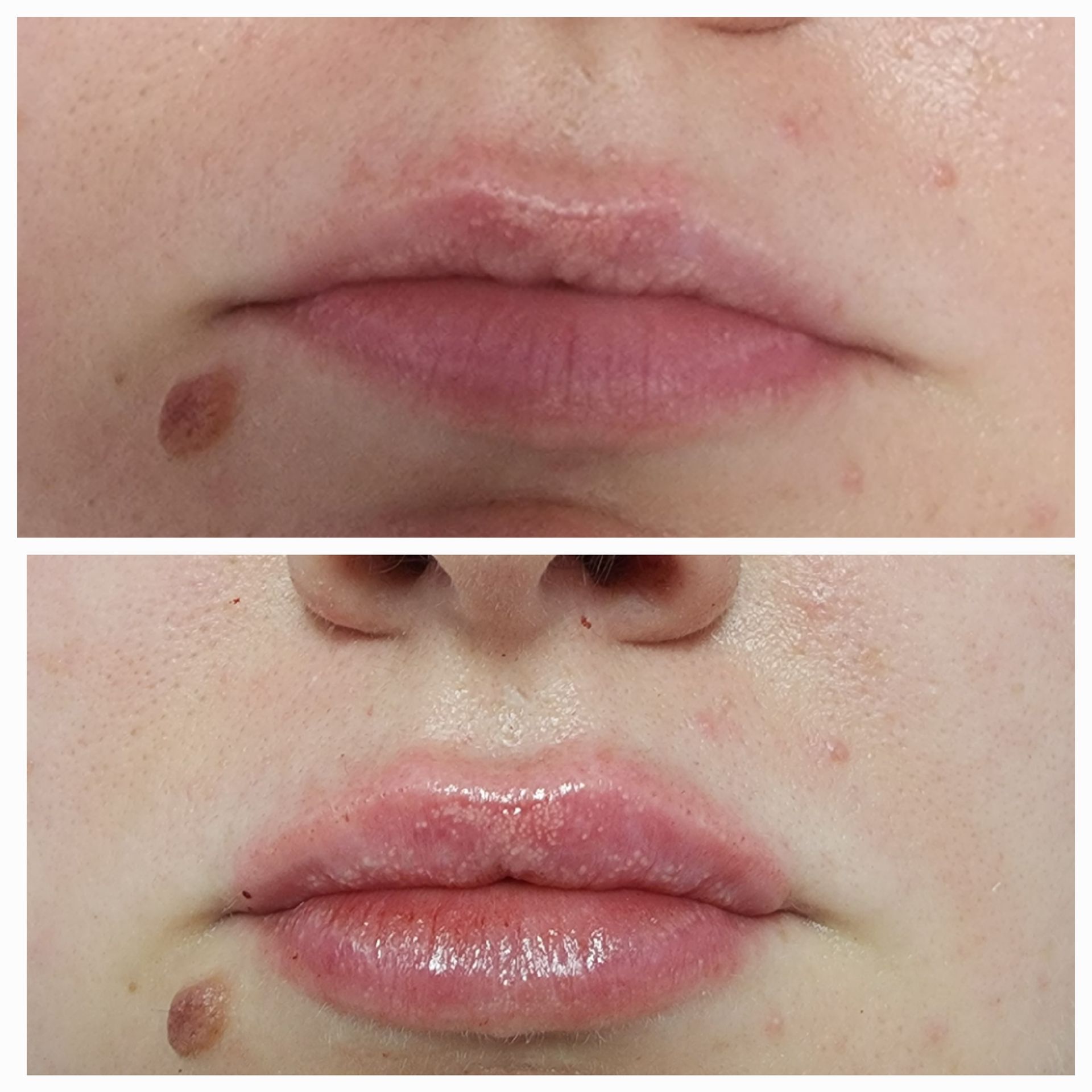 A before and after photo of a woman 's lips.