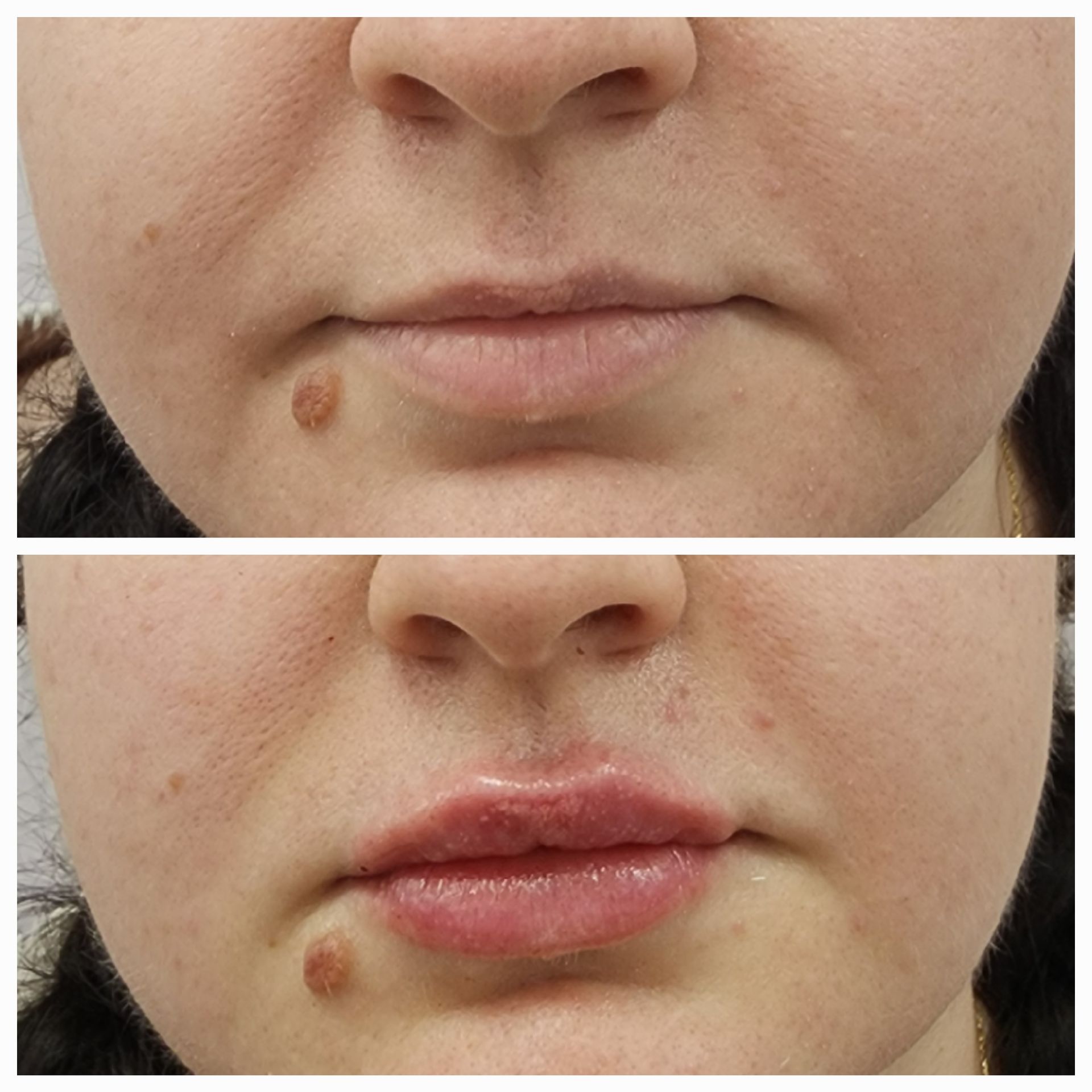 A before and after photo of a woman 's face with a mole on her lip.