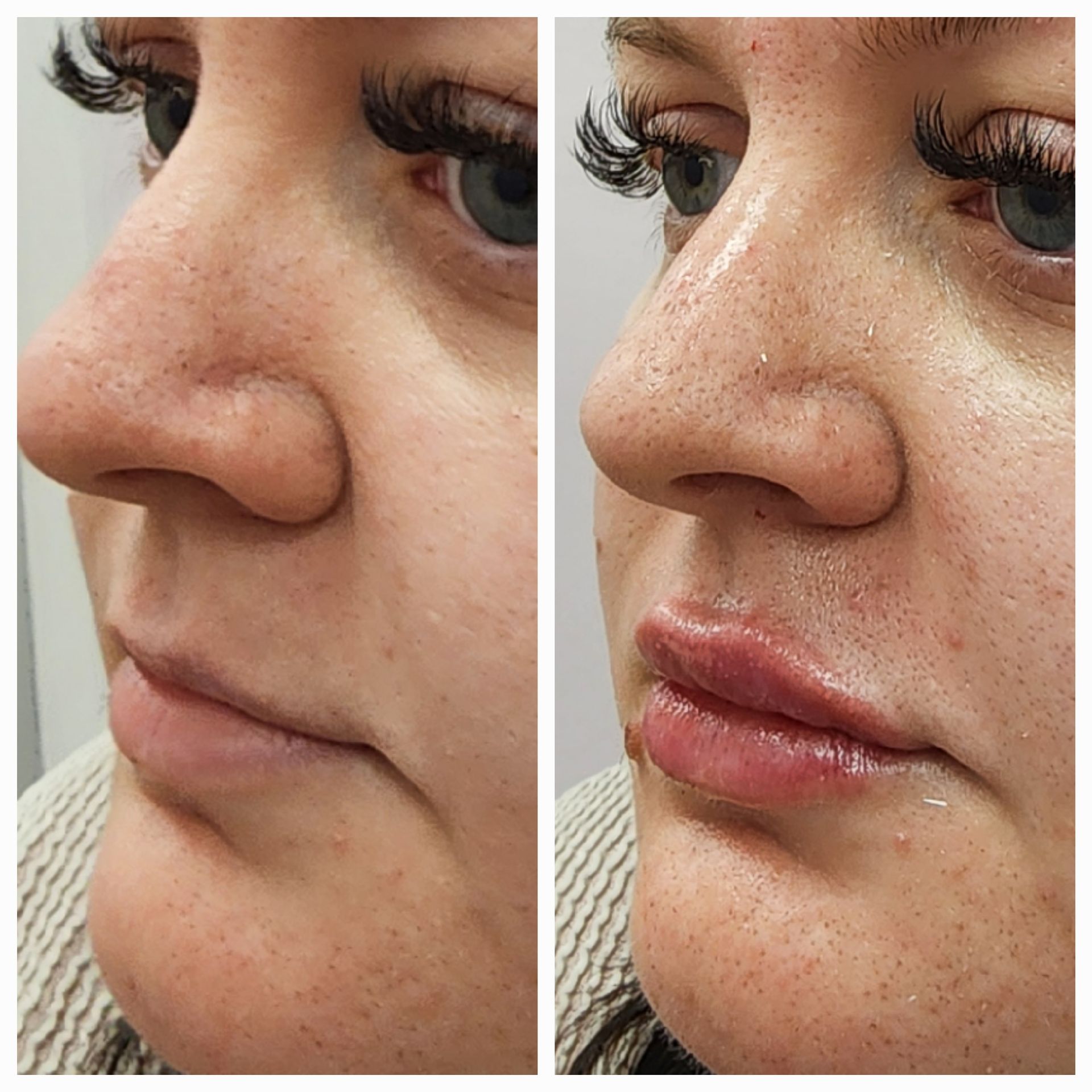 A before and after photo of a woman 's lips.