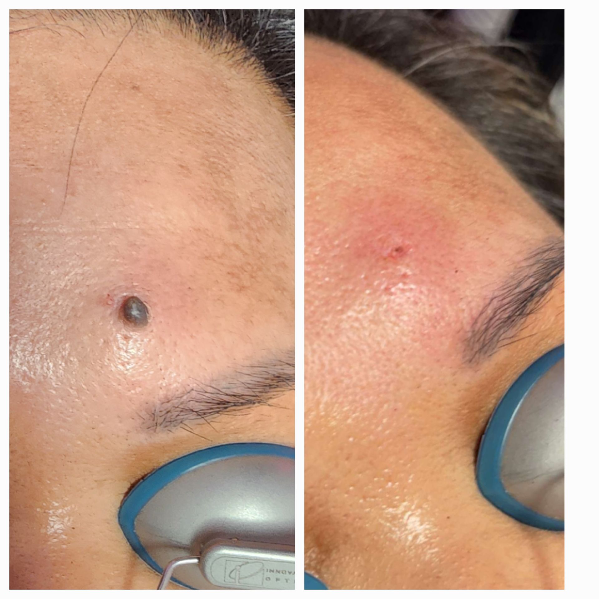 A before and after photo of a woman 's face with a mole on it.