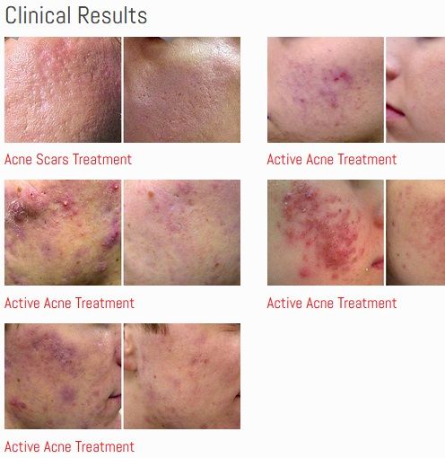 Clinical results of acne scars treatment and active acne treatment