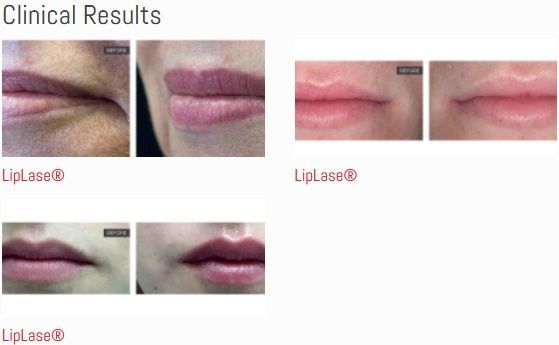 A picture of a woman 's lips before and after liplase treatment