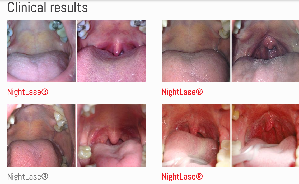 A collage of four pictures of a person 's mouth and throat.