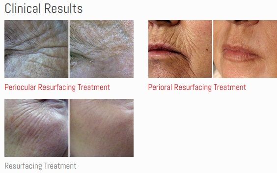 A picture of a woman 's face before and after a resurfacing treatment.