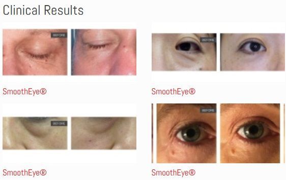 A picture of a woman 's eyes and the words clinical results