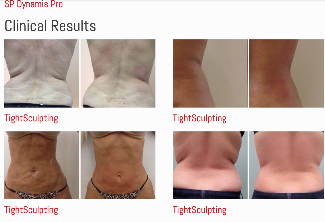 A picture of a woman 's stomach before and after tight sculpting